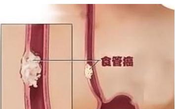 食道癌的易患人群有哪些？