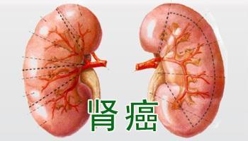 肾癌患者哪些食物不能吃？看完你就知道了