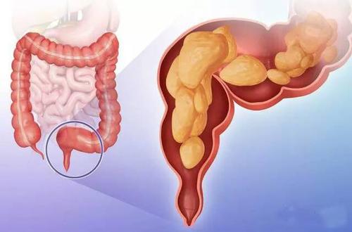 直肠癌的饮食应该注意什么？少吃油脂类食物